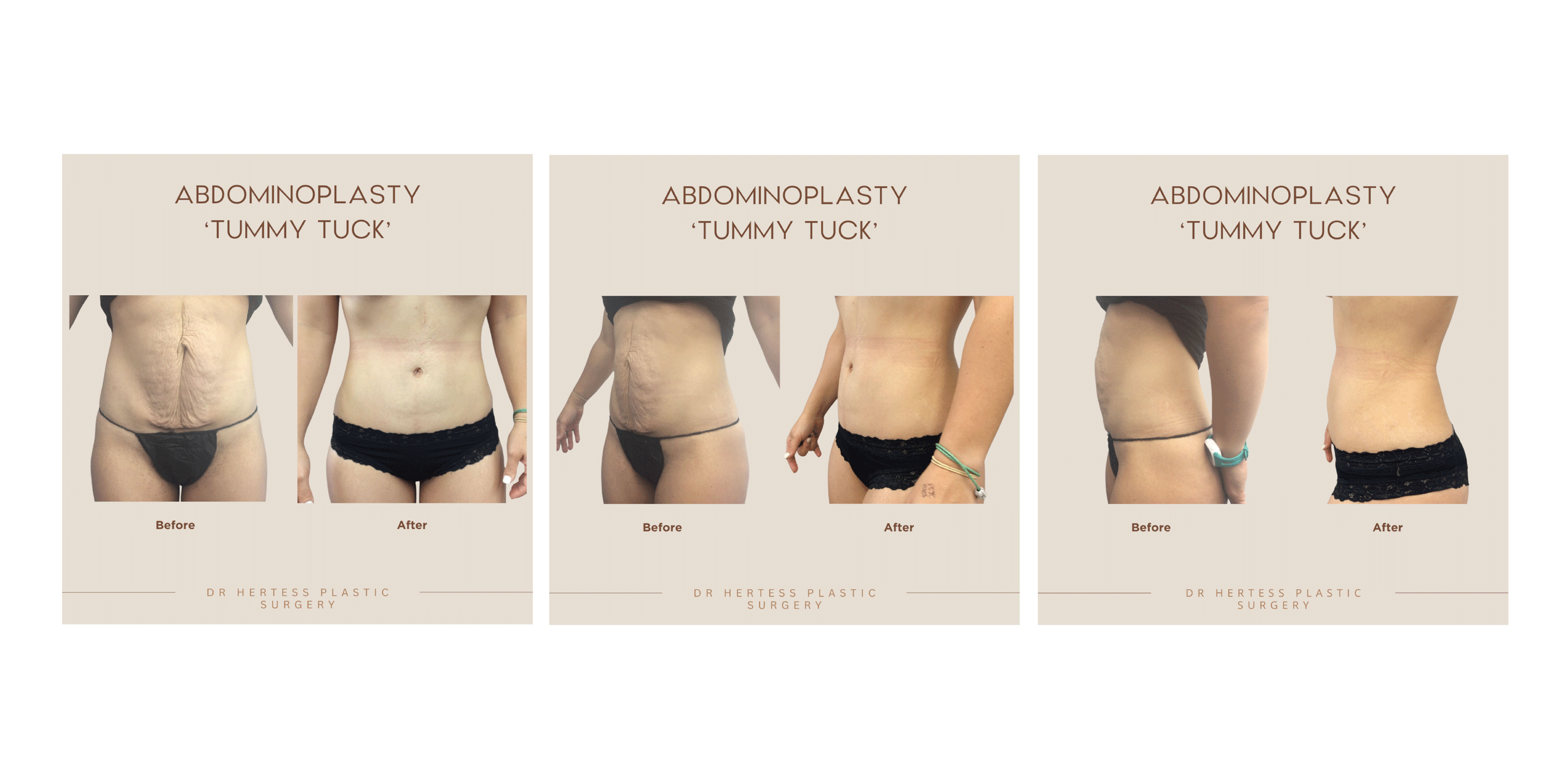 Abdominoplasty (Tummy Tuck)