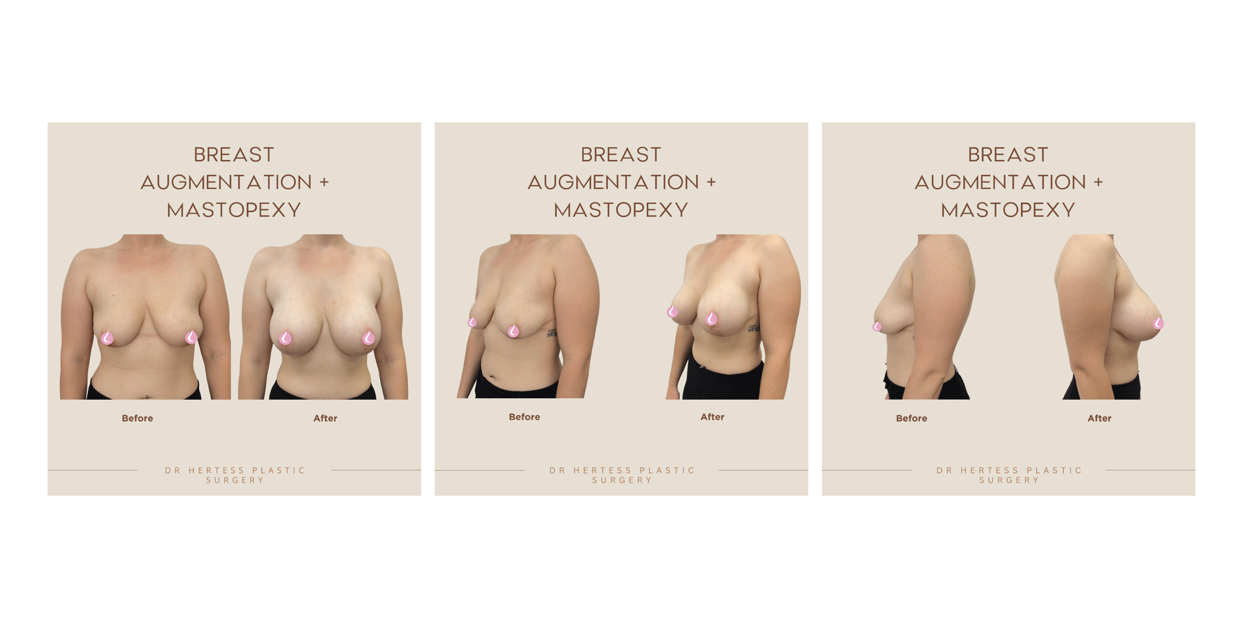 Augmentation Mastopexy