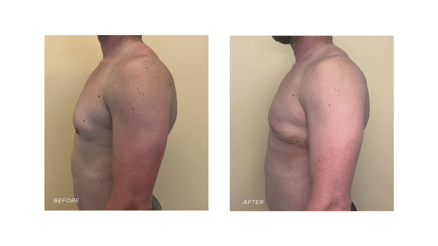 Gynaecomastia Surgery - Before & After