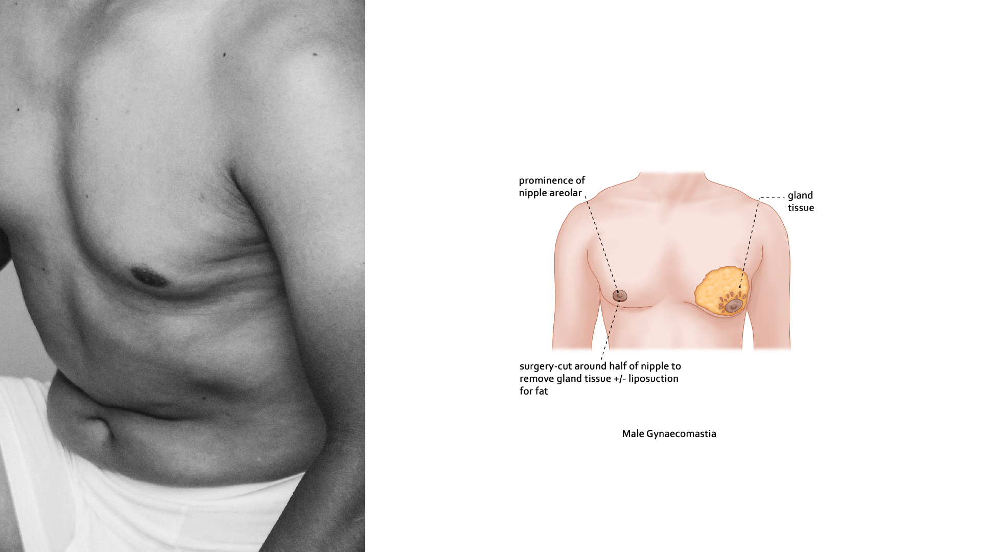 Gynaecomastia: treating "man boobs"
