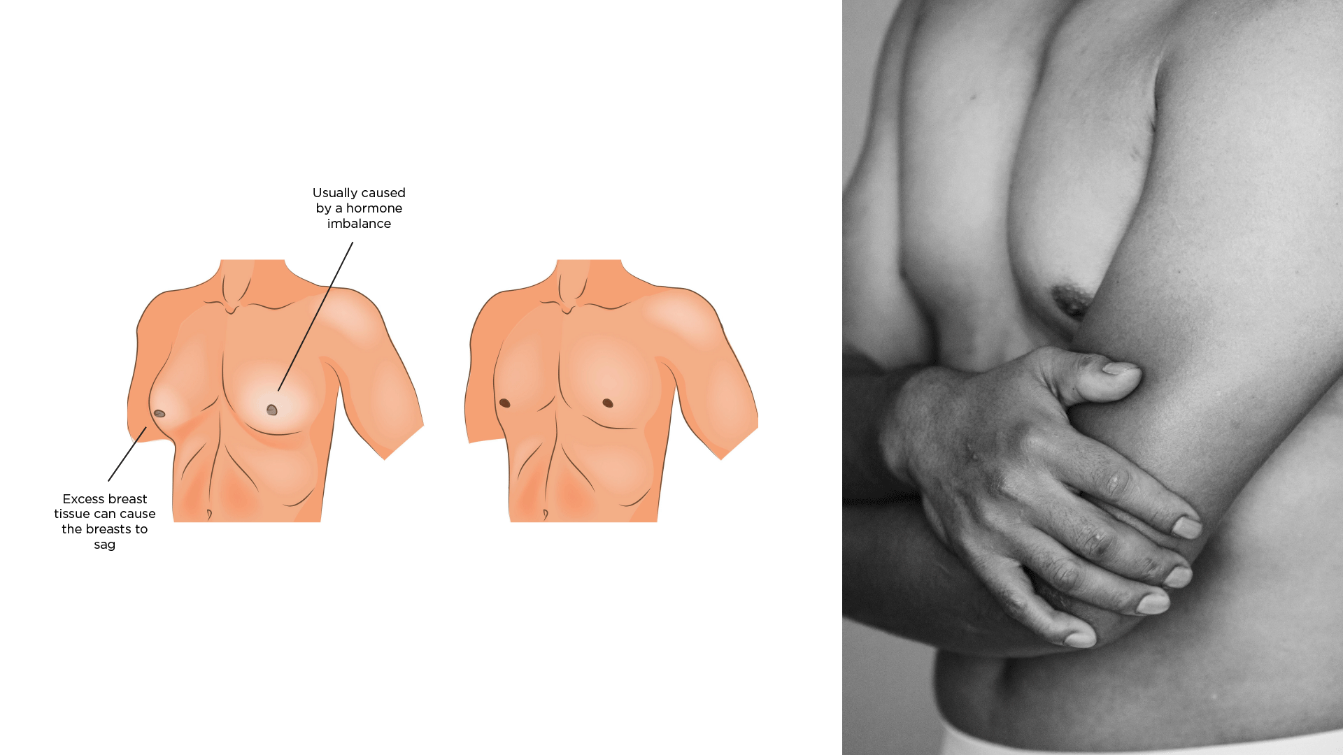 Gynaecomastia: treating "man boobs"