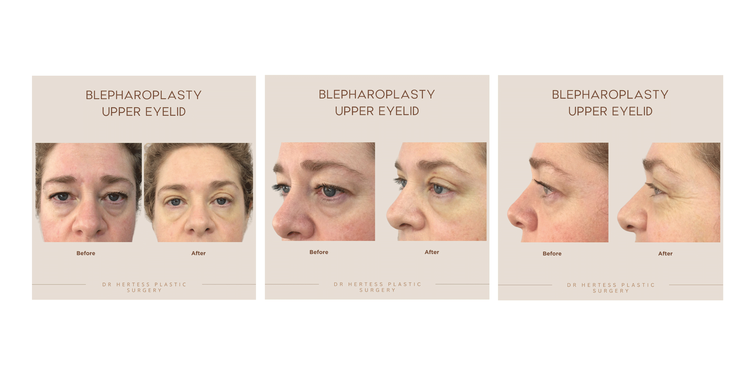 Blepharoplasty - Upper Eyelid Surgery