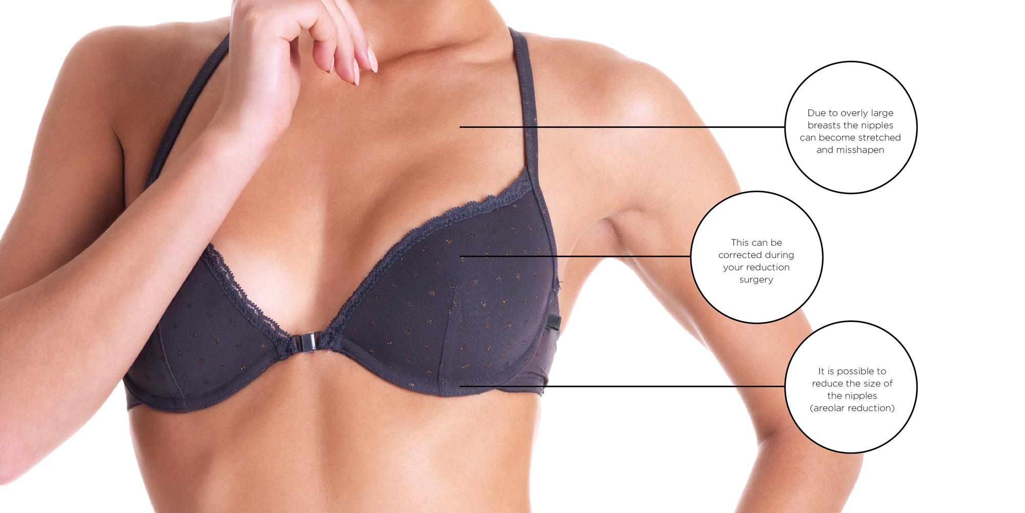 Nipple Reduction with Breast Reduction