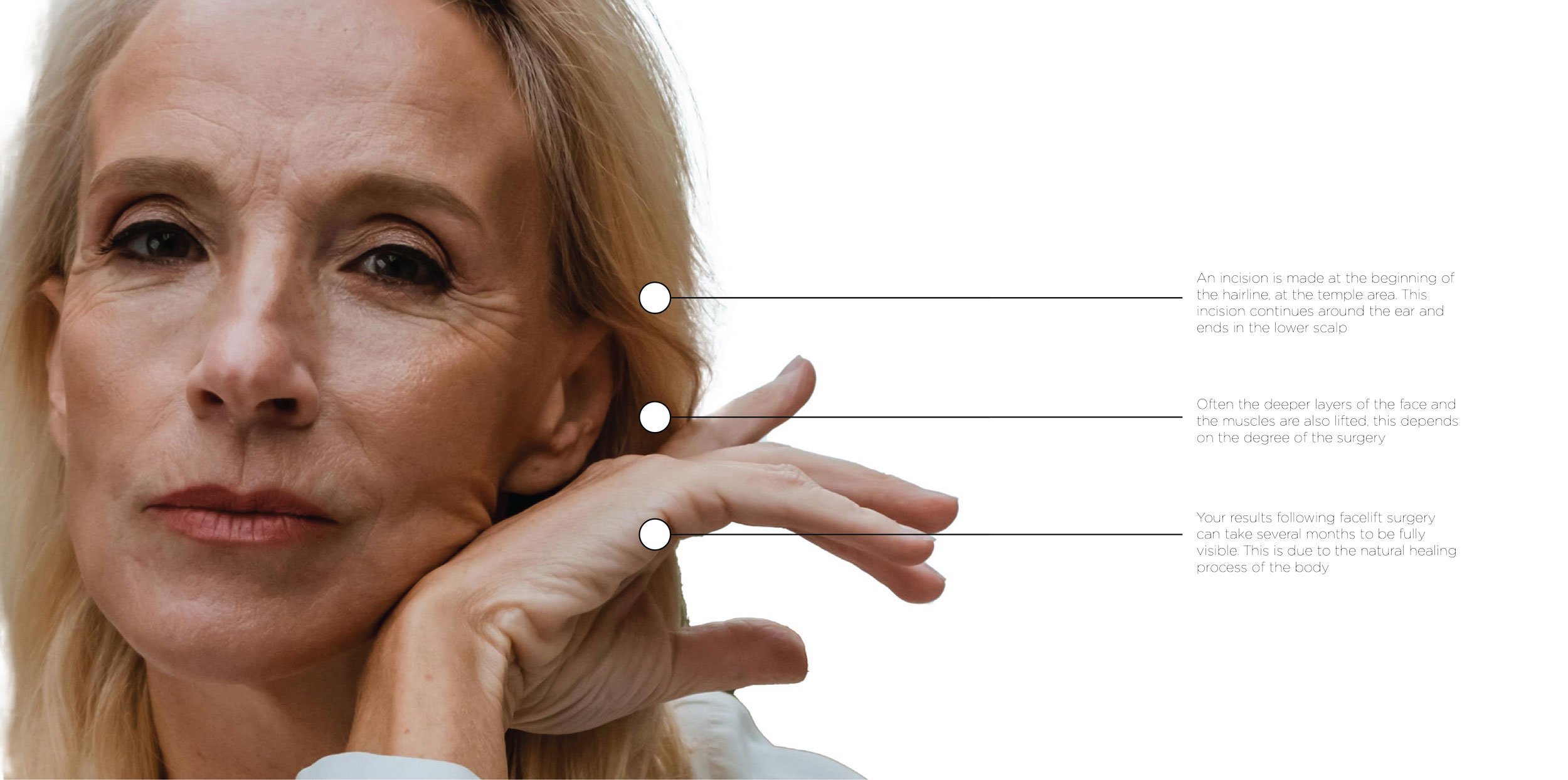 FAQ's - Facelift (contact us for a consultation today)