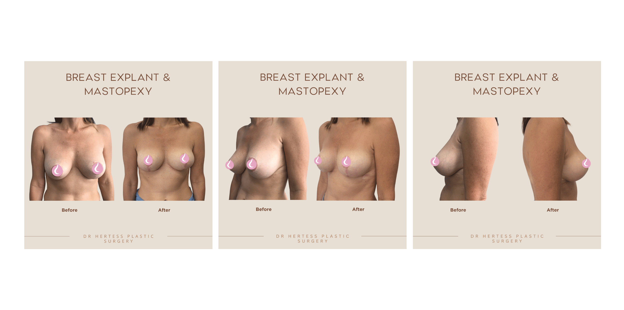 Breast Explant and Mastopexy