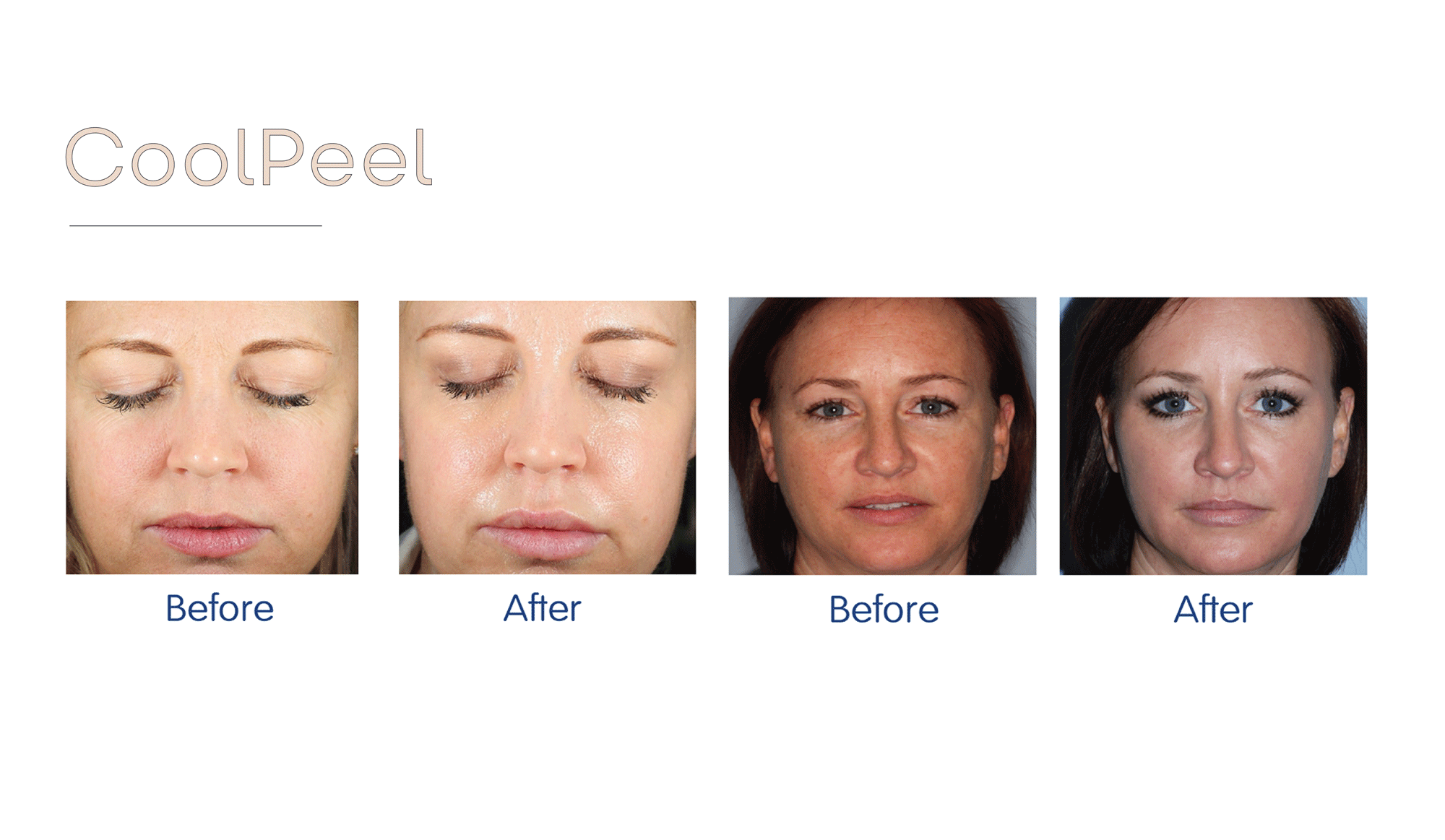 Incredible results from our revolutionary CoolPeel laser