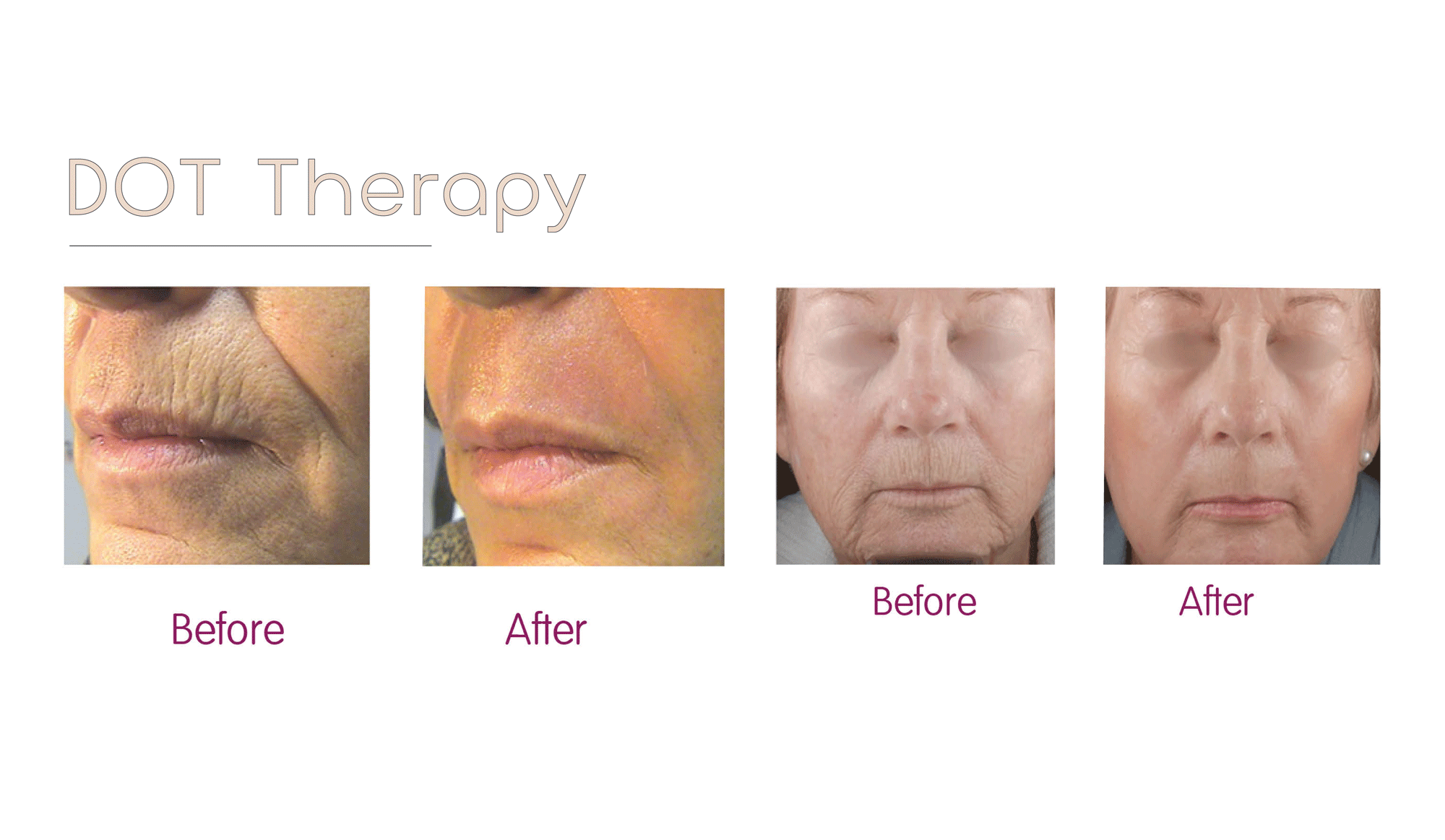 Outstanding results for DOT Therapy Fractional Laser at Dr Hertess Plastic Surgery