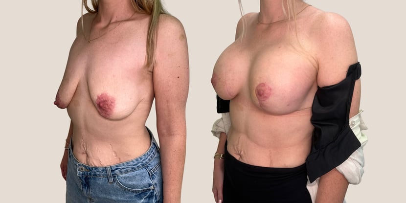 GalaFLEX_Internal_Bra_2